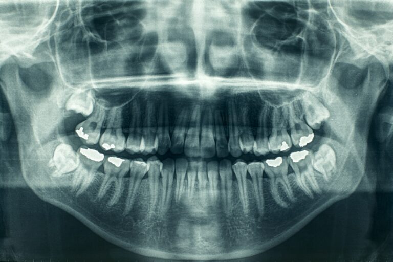 Panoramic dental X-Ray